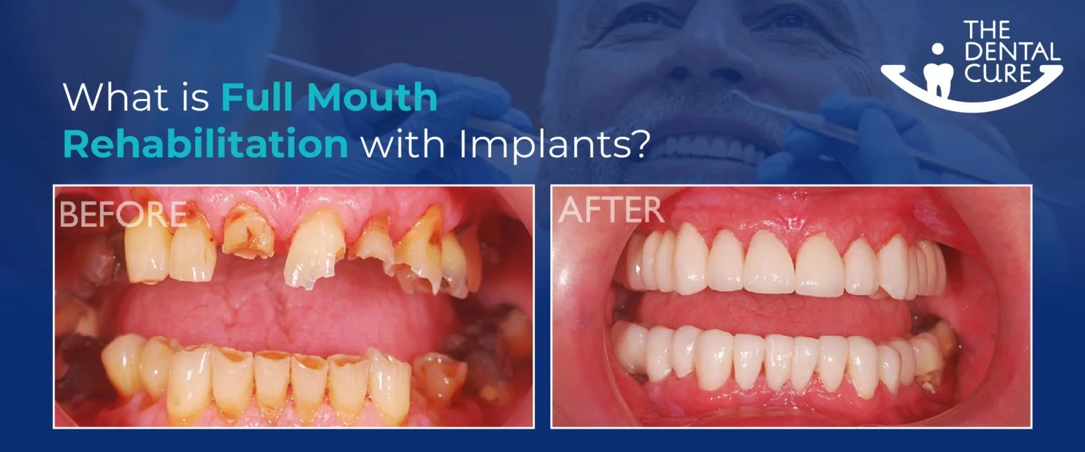 What Is Full Mouth Rehabilitation With Implants?