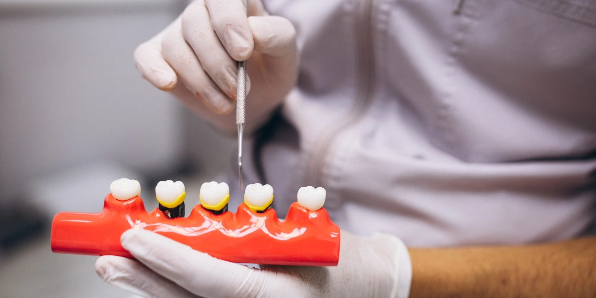Why Are Dental Implants So Affordable in India?