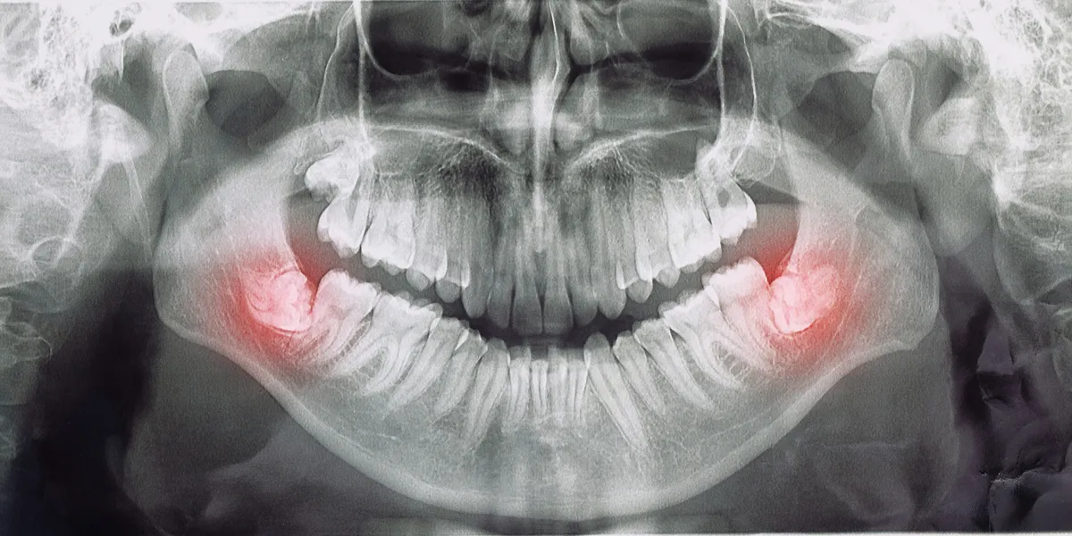 6 Major Wisdom Teeth Symptoms: Signs You Should Not Ignore