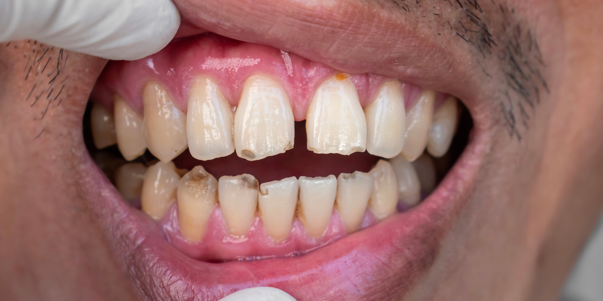 What Causes Black Teeth in Adults? Causes & Treatment