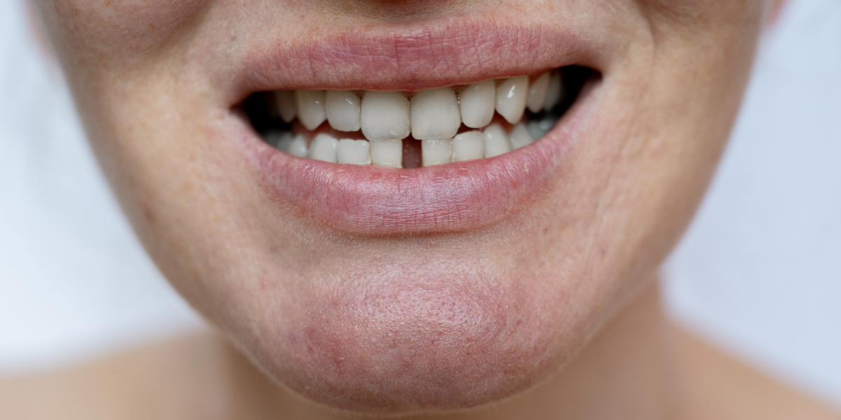 How to Fill the Gap Between Teeth? 5 Treatment Options