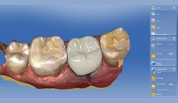 CEREC CAD Design Image 2