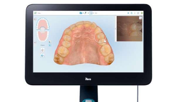 iTero Scanner Image 1