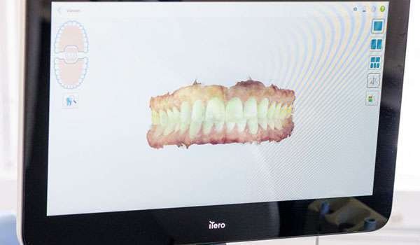 iTero Scanner Image 2