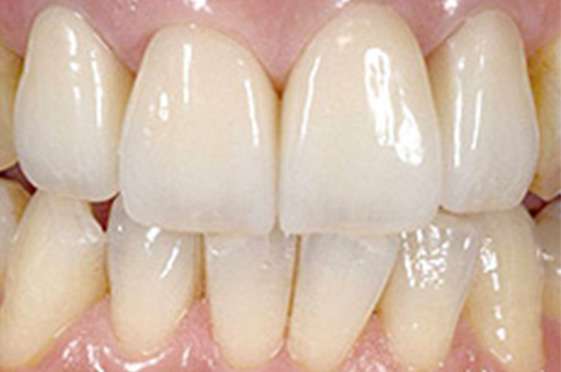 After Crowns Treatment & Zirconia Crown