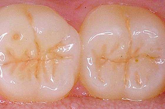 Pit and fissure sealants