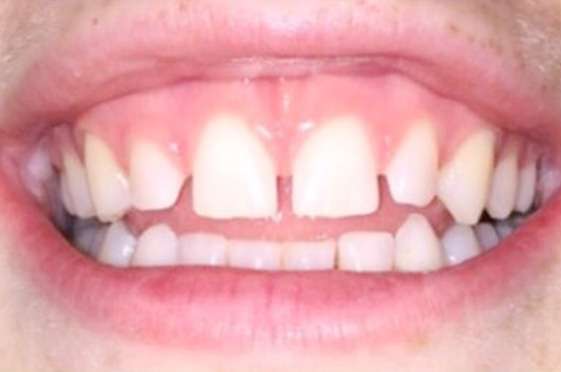 Before teeth gap removal treatment