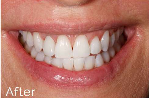 After Veneer Treatment