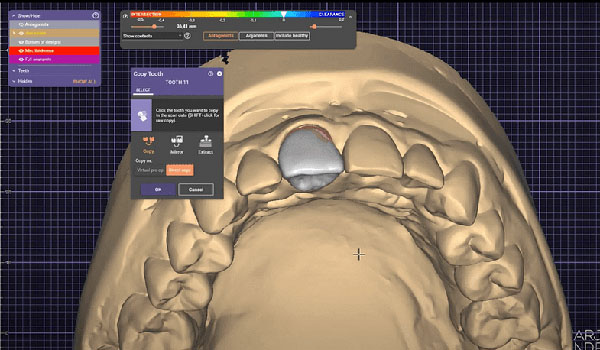 exocad-software-for-dsd-01