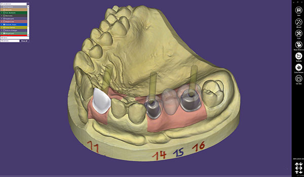 exocad-software-for-dsd-02