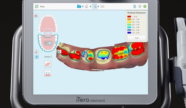 itero-3D-intra-oral-scanners-01