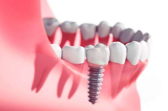 basal implants india