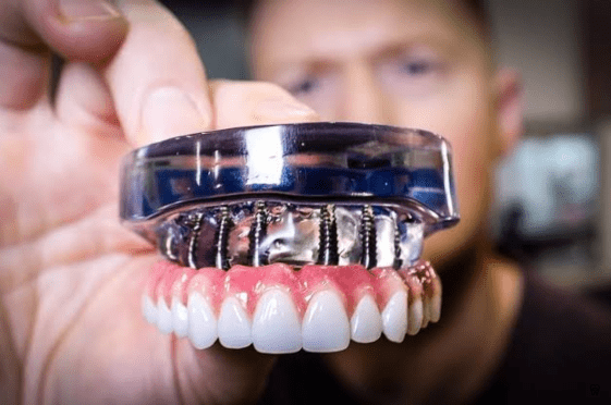 Dental Implants in India