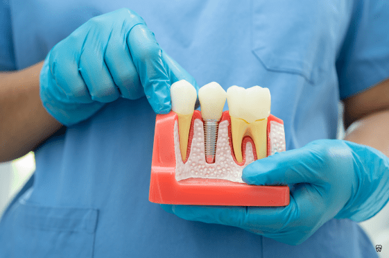 Root Canal Treatments