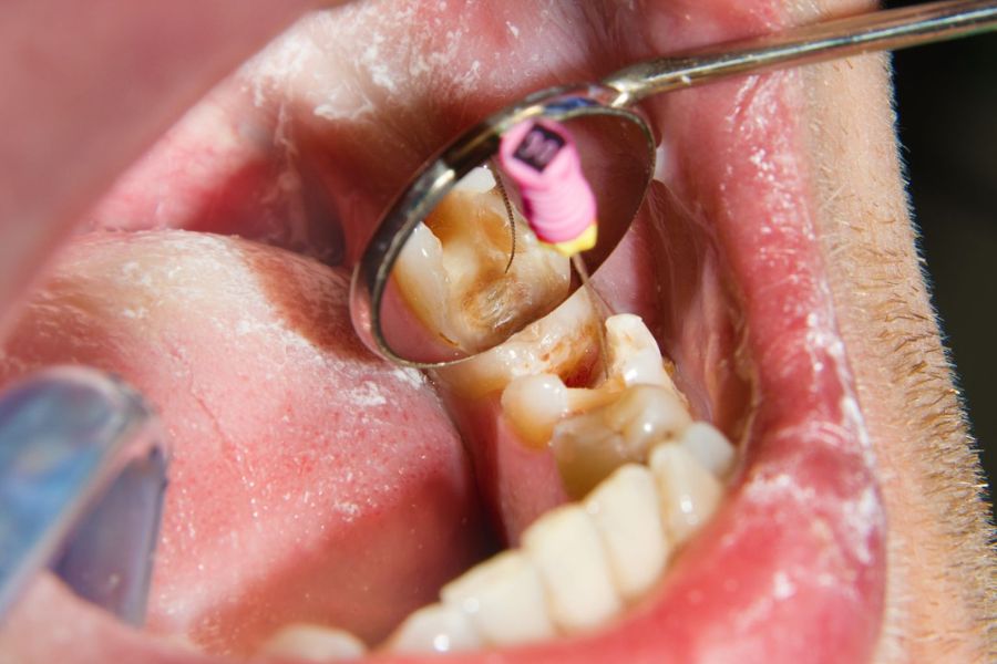 Root Canal Treatment Process