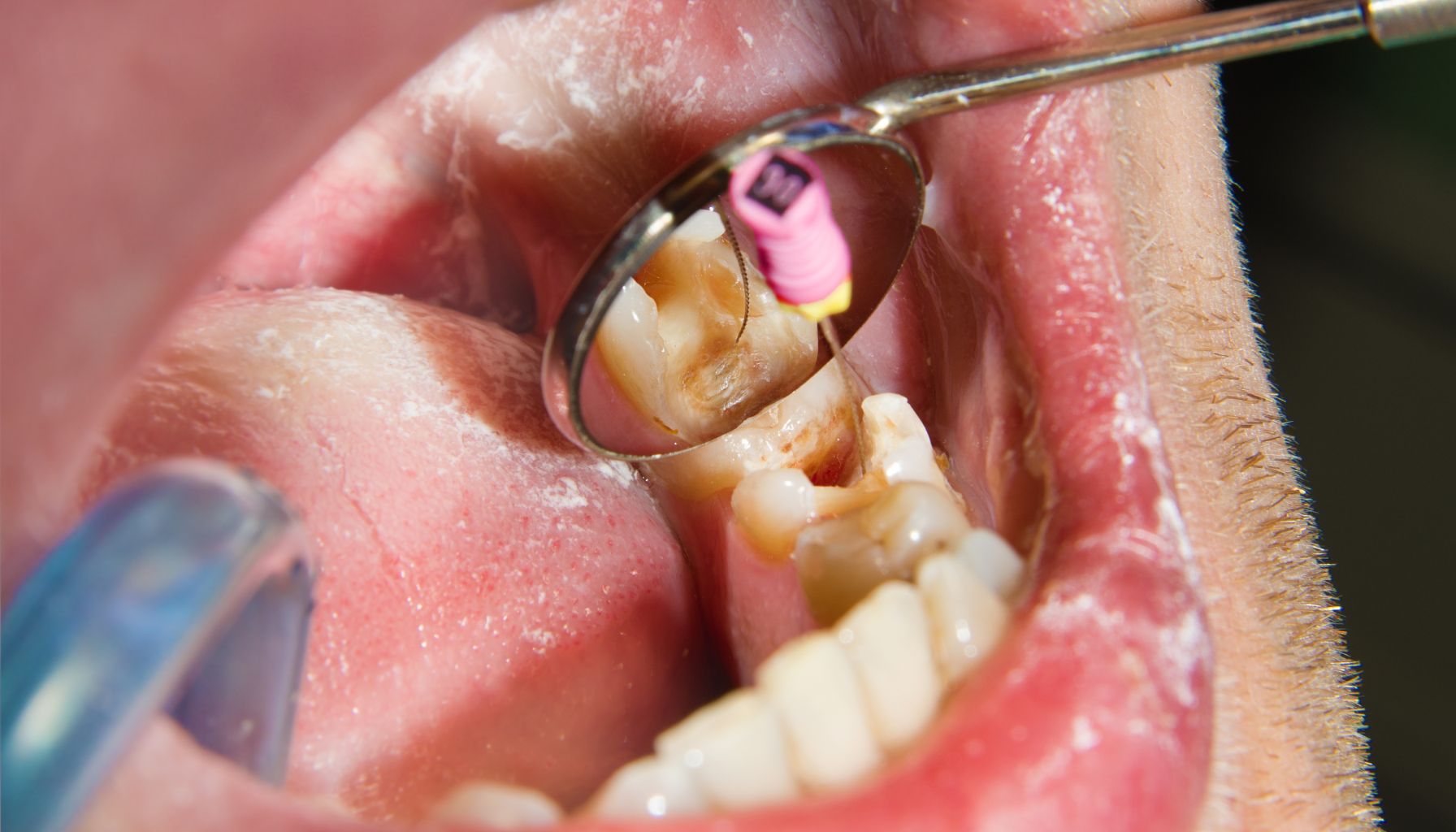 Root Canal Treatment Process