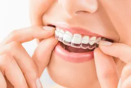 تقويم شفاف (Invisalign)