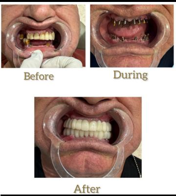 dental implants before, during and after