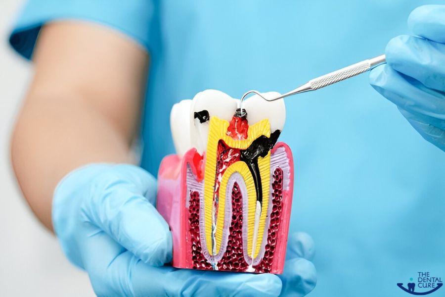 Root Canal Treatment in Gurgaon