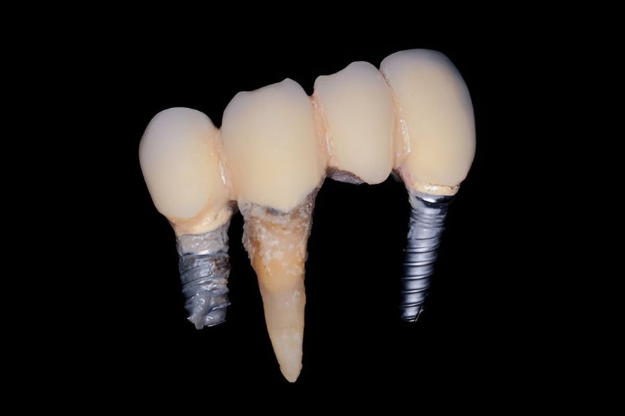 Can Dental Implants Fail