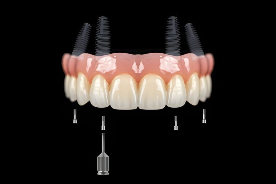 Dental Implants