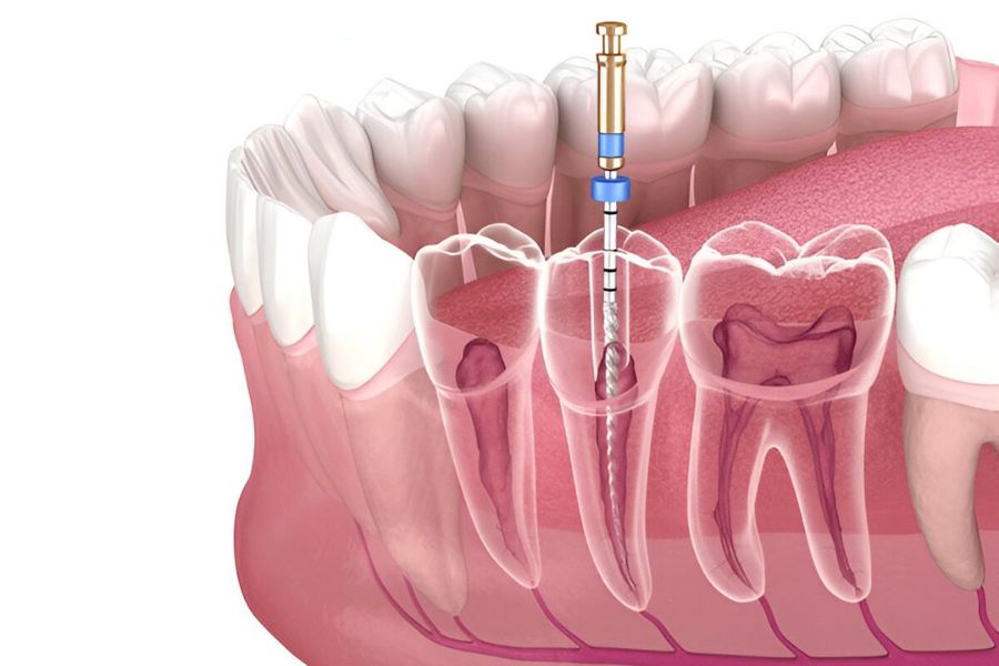 Molar Root Canal