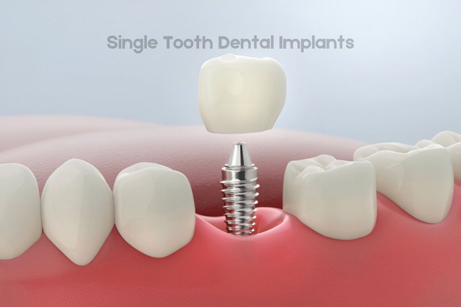 Single Tooth Dental Implants Gurgaon