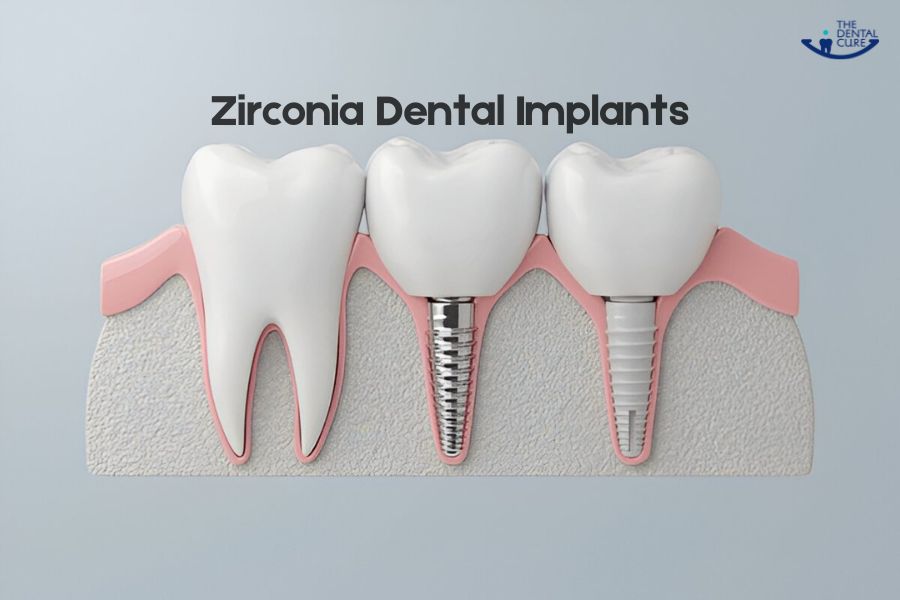 Zirconia Dental Implants in Gurgaon