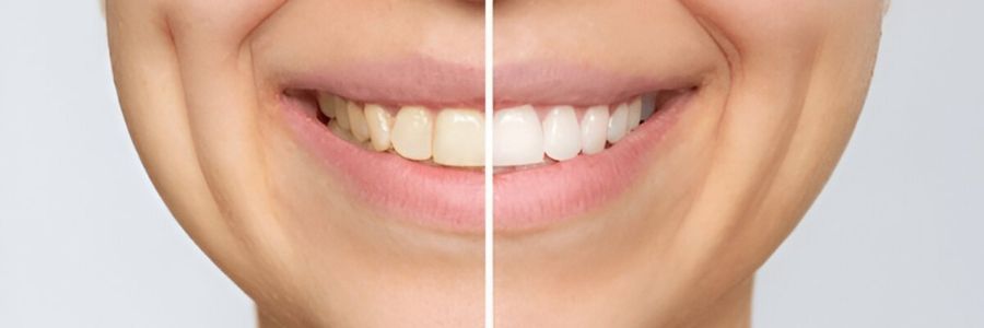 Teeth Whitening / Bleaching