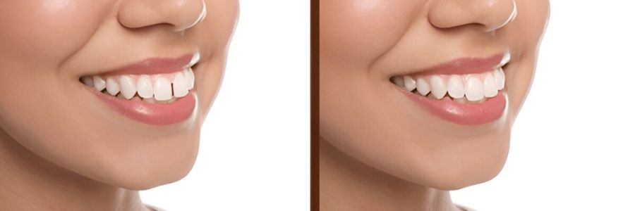 Gap Closure & Tooth Reshaping