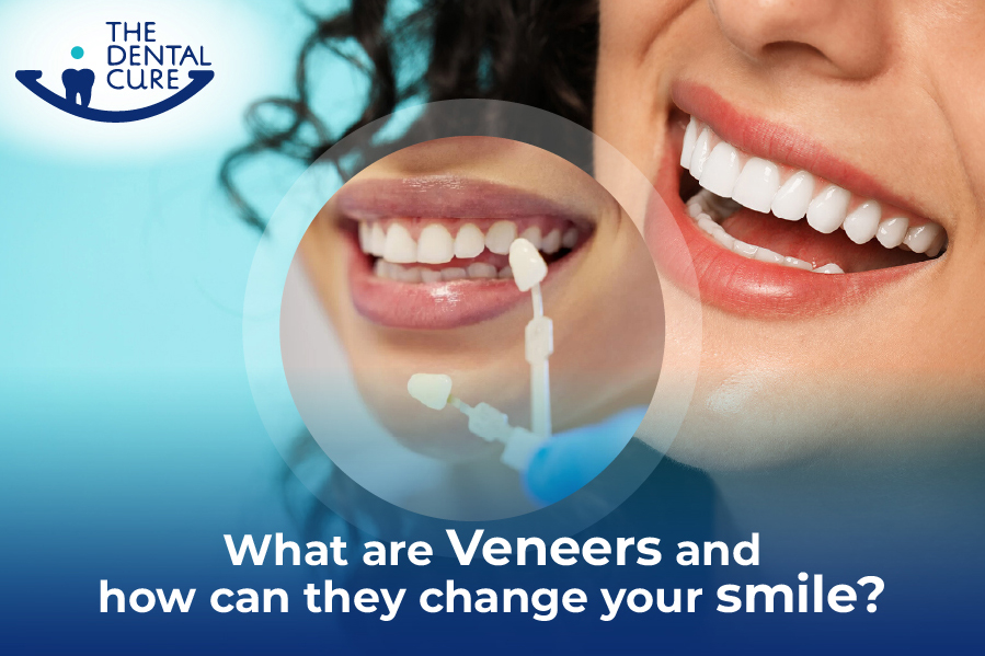 veneers