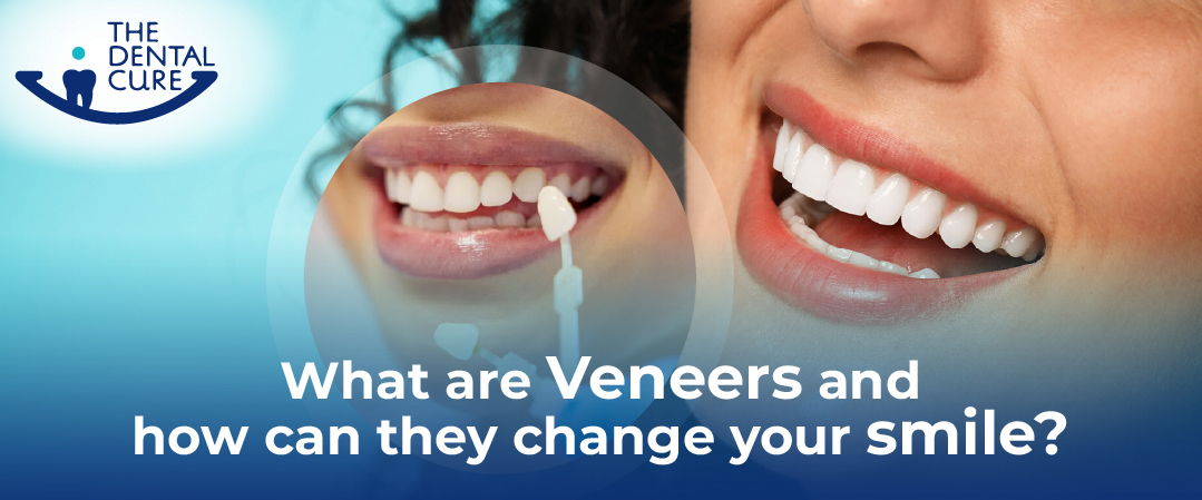 veneers